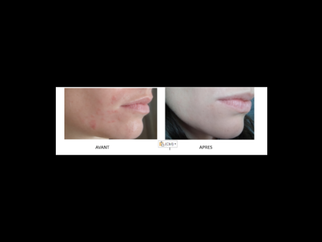 Témoignage – Eczéma au visage : disparition après une séance de kinésiologie !